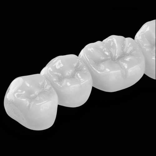 All-Ceramic Restorations for Superior Esthetics and Biocompatibility