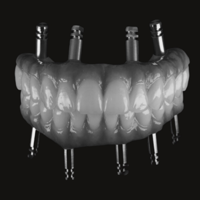 Dental implants
