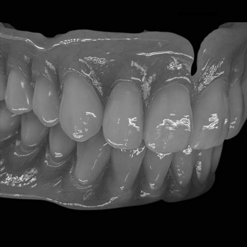 Custom Dentures for Comfort, Function, and Natural Esthetics