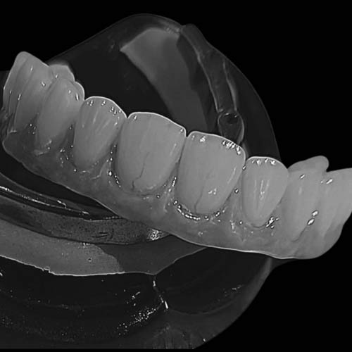 Implant-Supported Restorations for Precision, Stability, and Long-Term Success