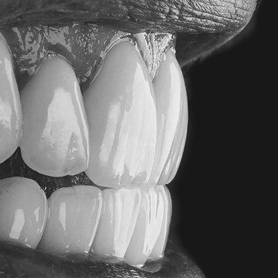 Lux no-prep veneers