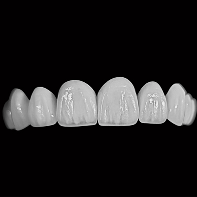 Porcelain veneers