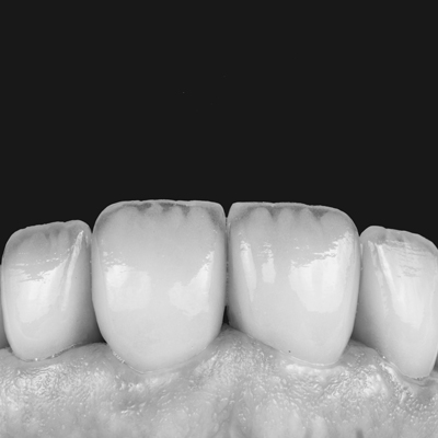 Ultra thin veneers