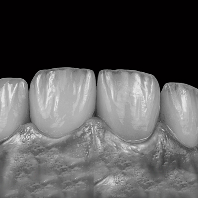 Emax pressed ceramic veneers