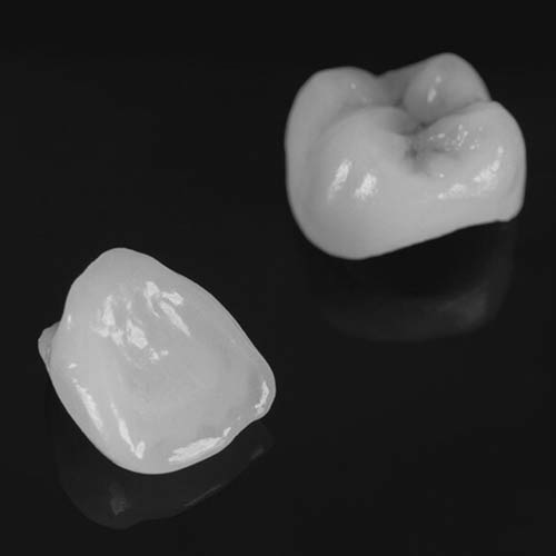 IPS e.max Restorations for Natural Aesthetics and Strength