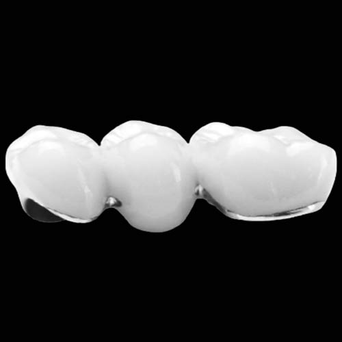 PFM Crowns and Bridges for Reliable, Cost-Effective Restorations
