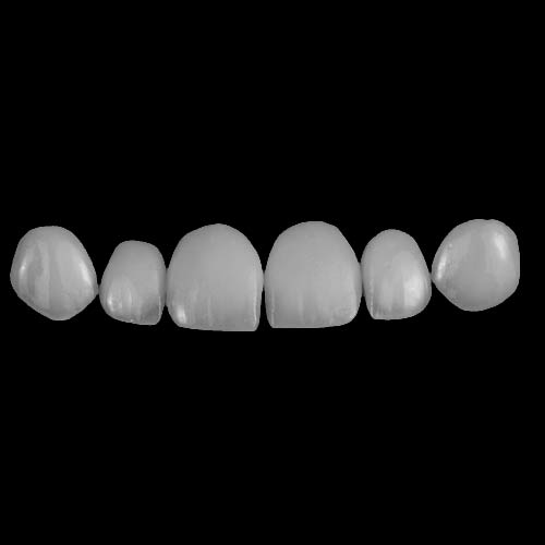 Custom Dental Veneers for Natural, High-End Smile Design